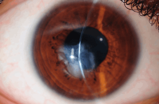 Keratokonus Hornhautverletzung Hornhauttrübung Auge 