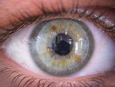 Hartlinse formstabile Linse KontaktlinsenSalzburg Individuallinsen Keratokonuslinse