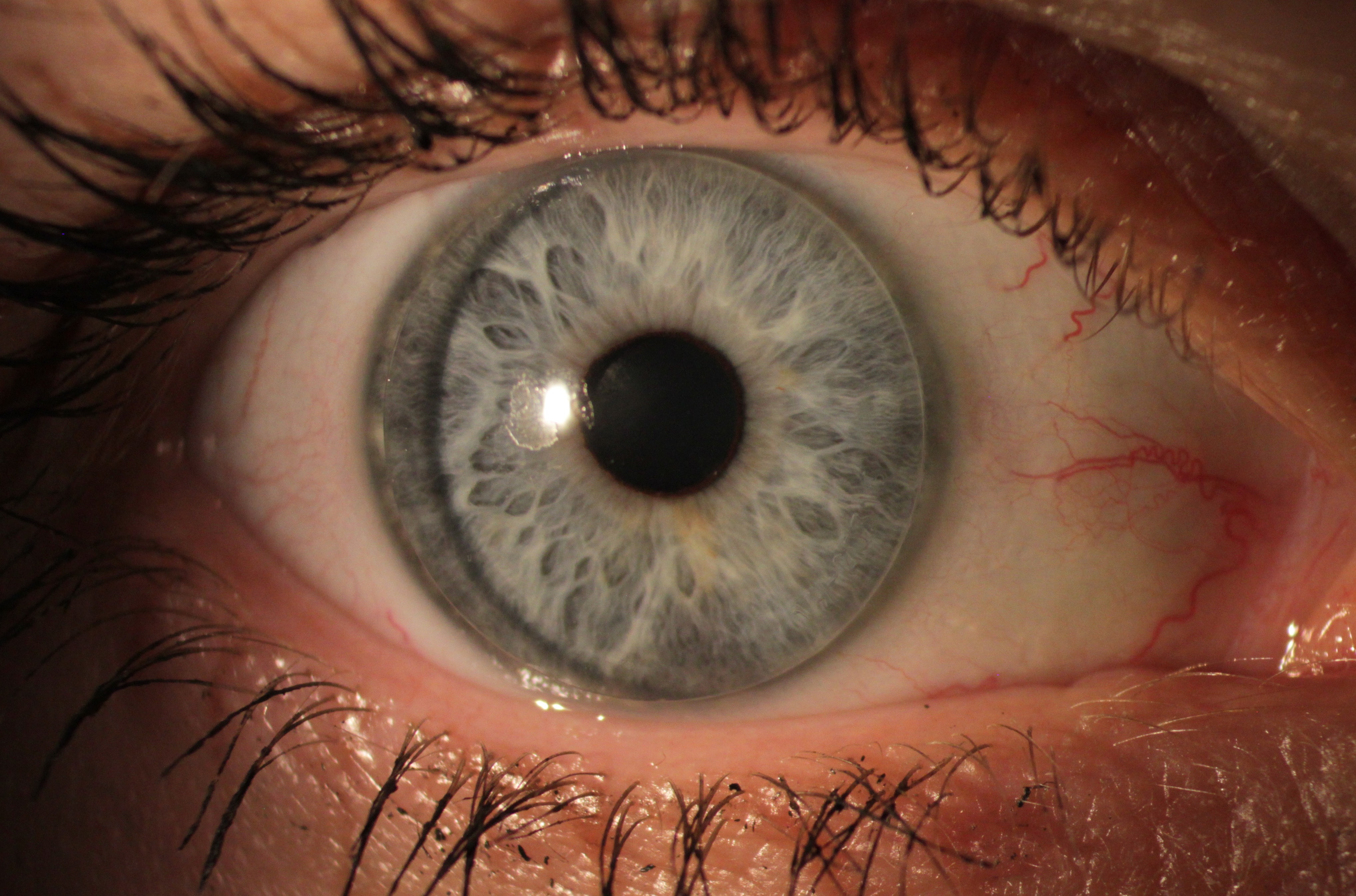 Hartlinse Ortho-K Nachtlinse formstabileLinse Kontaktlinsenspezialist Kontaktlinsenistitus 